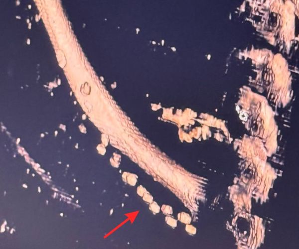 jobb_kulcscsont_gyongy_GD